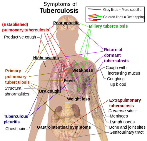 Perbezaan antara radang paru -paru dan tuberkulosis