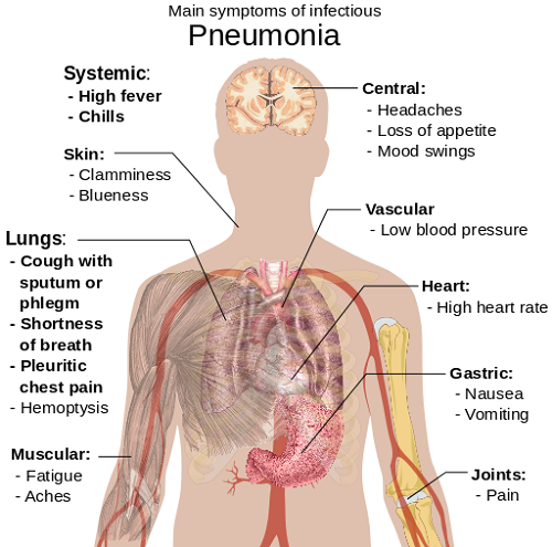 Perbedaan antara pneumonia dan tipus