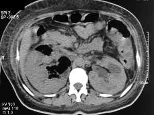 Unterschied zwischen Pyelitis und Pyelonephritis