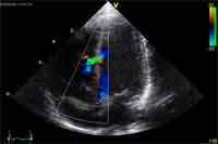 Perbezaan antara ultrasound dan sonogram