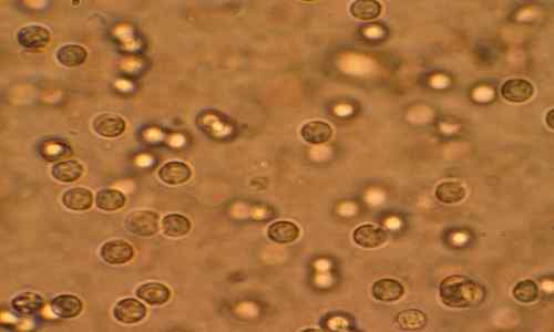 Diferencia entre la infección del tracto urinario superior e inferior