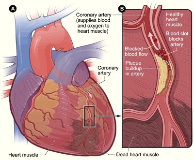 Différences entre l'anxiété et la crise cardiaque