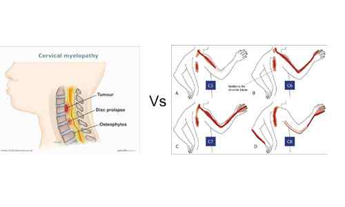 Différences entre la myélopathie et la radiculopathie