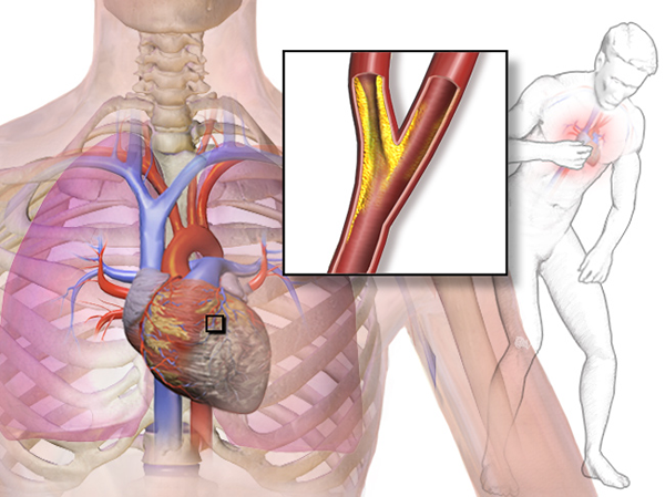 Différences entre l'ischémie myocardique et l'infarctus du myocarde