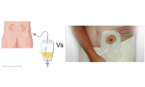 Différences entre la néphrostomie et l'urostomie