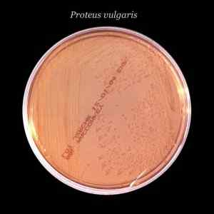 Diferencias entre la pielonefritis y la infección urinaria