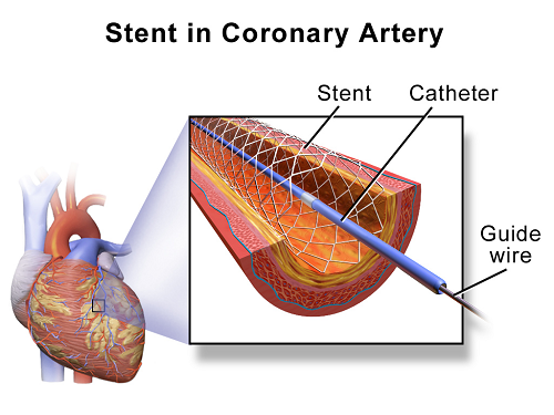 Comment le stent varie-t-il du passage?