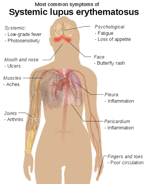 La différence entre le cancer et le lupus