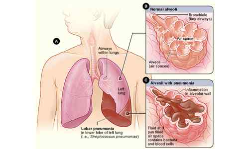 Apa perbedaan antara pneumonia ringan, sedang dan parah